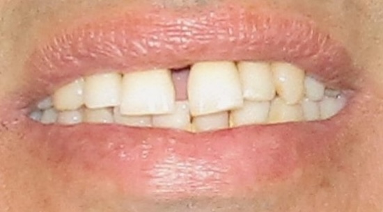 Alex before